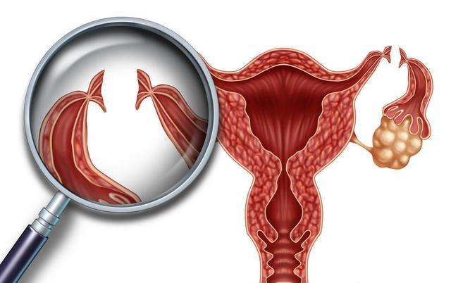 右侧输卵管通而不畅怎么检查？